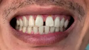 Teeth Gaps
