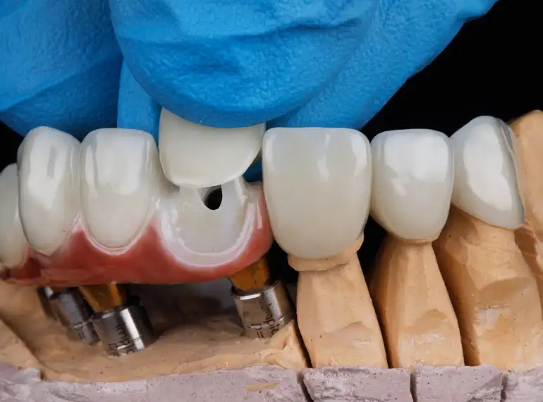 Dental Crown in Gurgaon