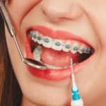 Teeth Braces