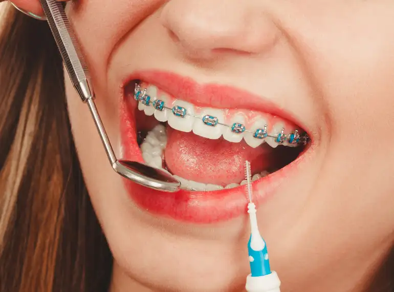 Teeth Braces