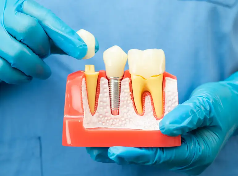 Artificial tooth placement