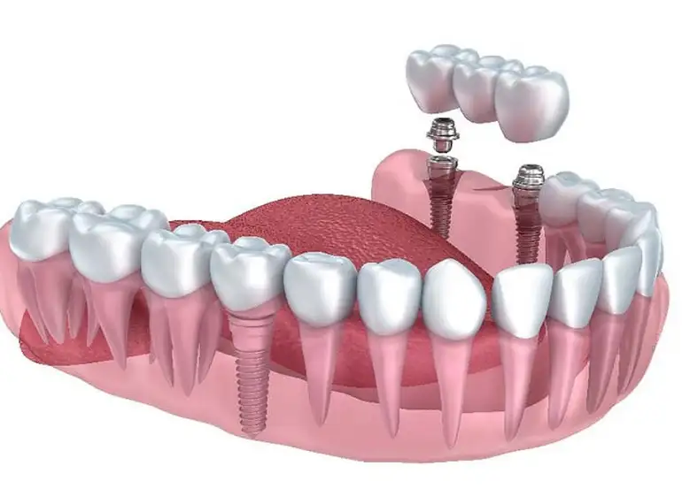 Implant Retained Dentures in Gurgaon