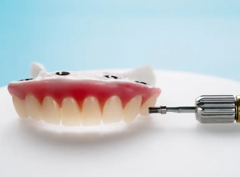 Implant-Supported Bridges