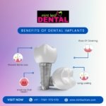 Life Changing Benefits of Dental Implants.
