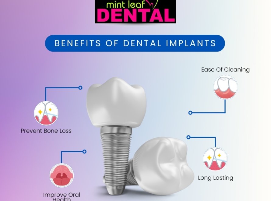 Life Changing Benefits of Dental Implants.