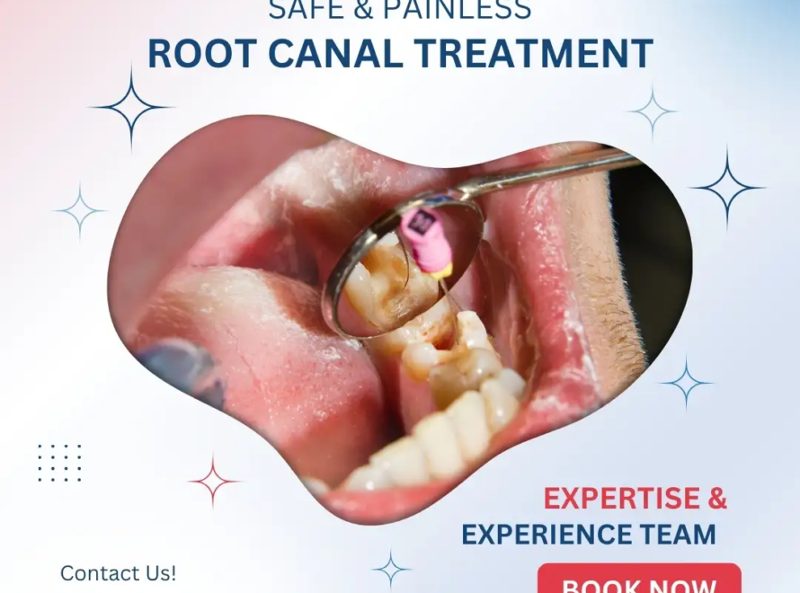 Safe & Painless Root Canal Treatment in Gurgaon
