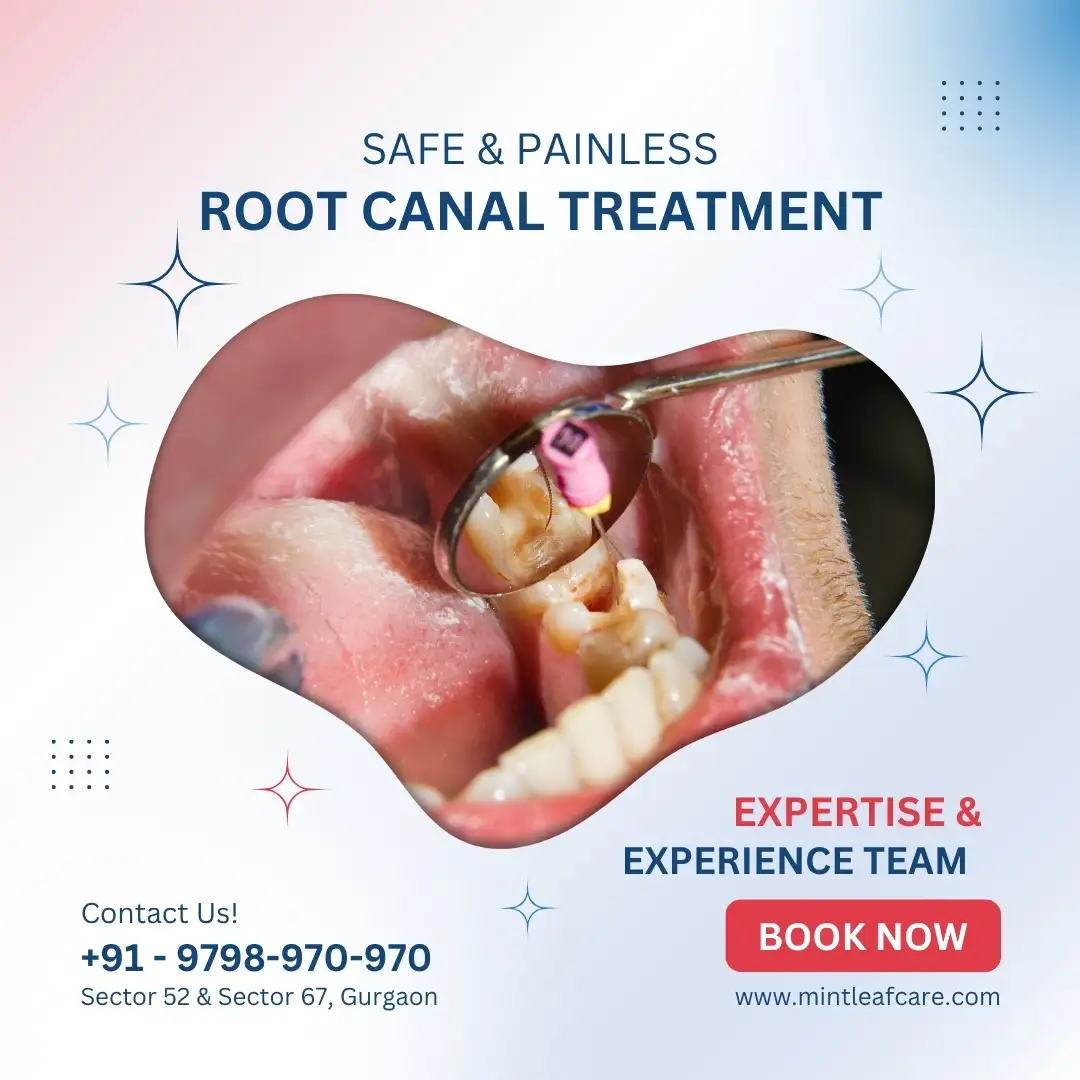 Safe & Painless Root Canal Treatment in Gurgaon