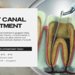 Painless Root Canal Treatment in Gurgaon