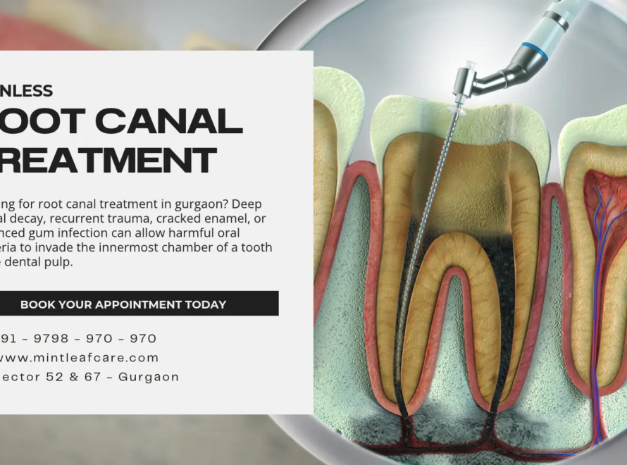 Painless Root Canal Treatment in Gurgaon