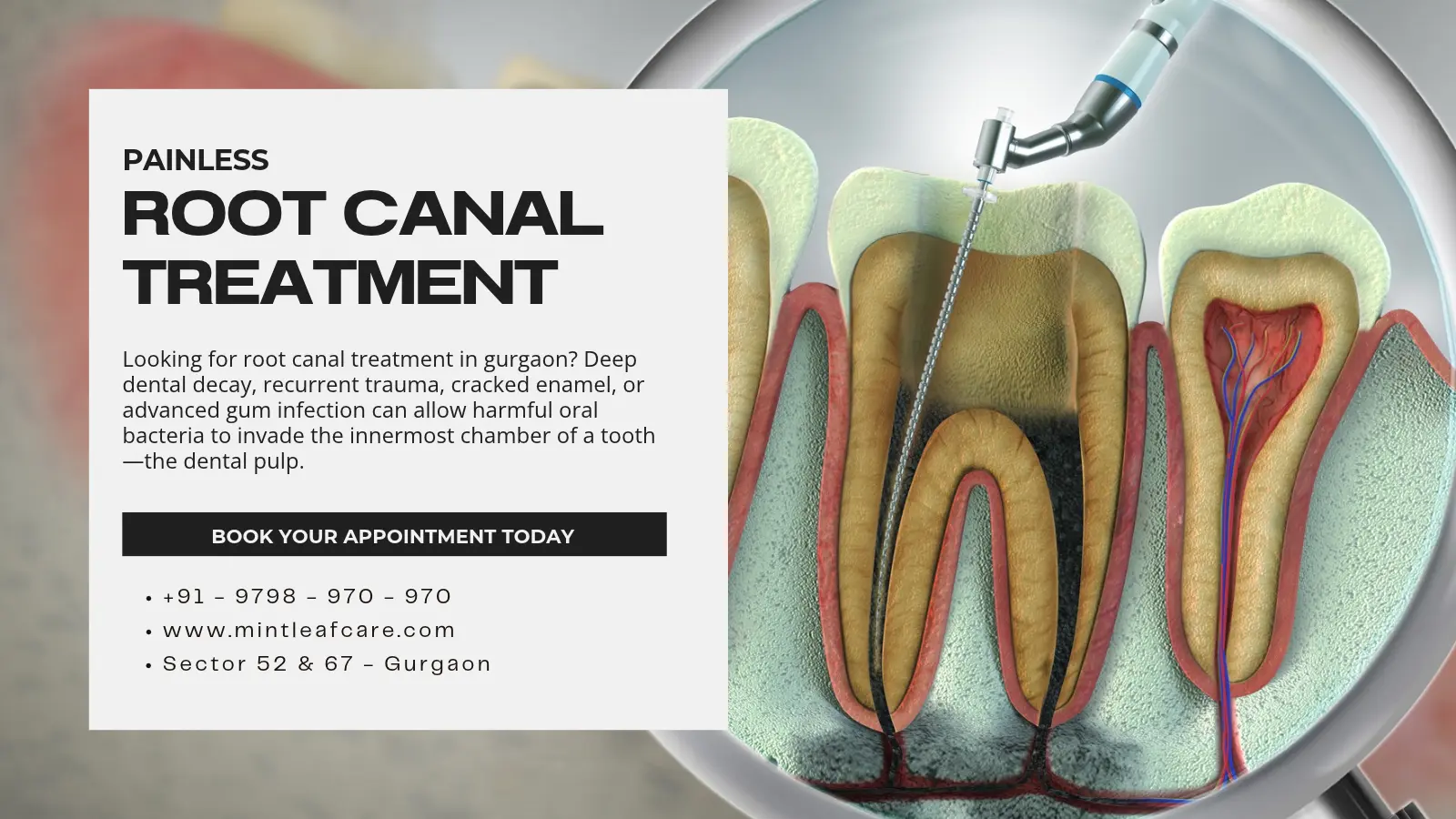 Painless Root Canal Treatment in Gurgaon