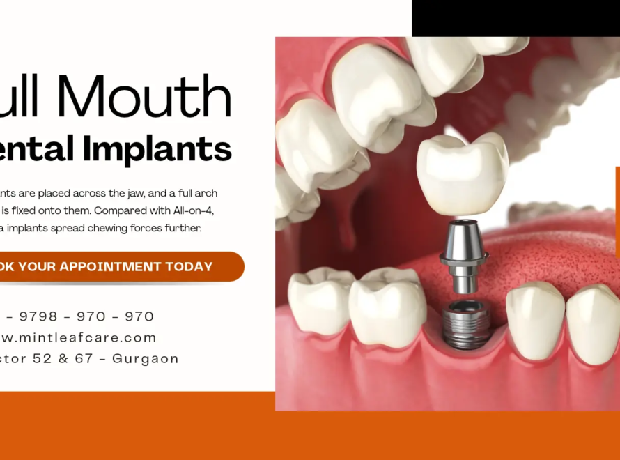 Full Mouth Implants in Gurgaon
