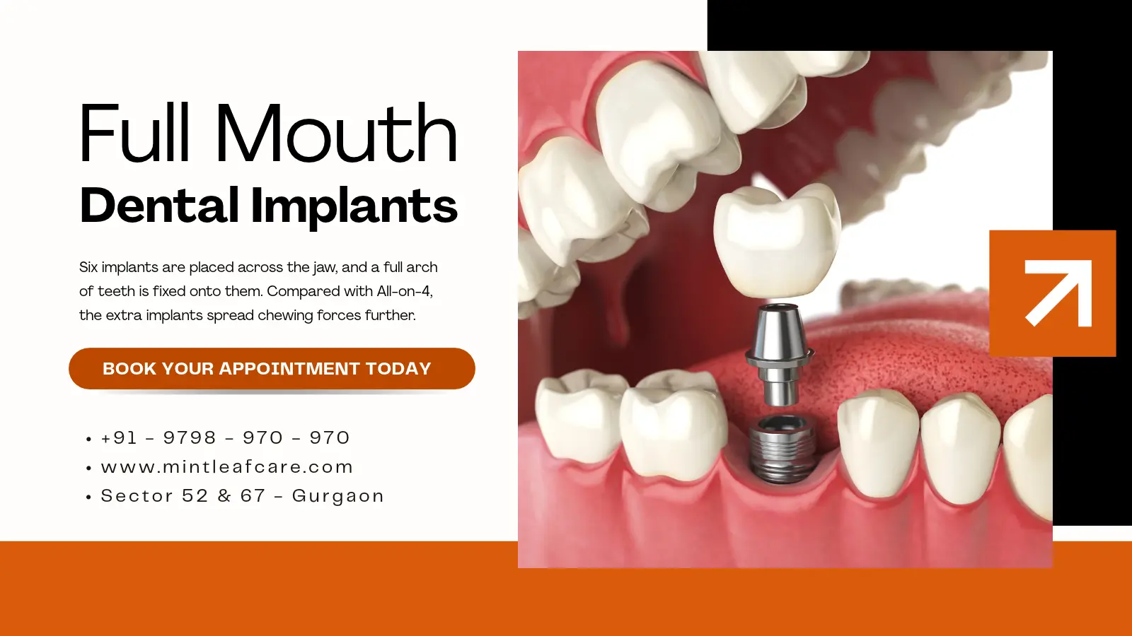Full Mouth Implants in Gurgaon